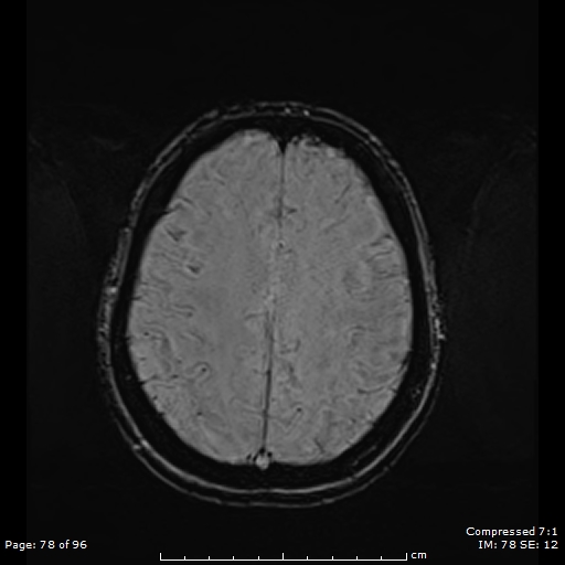 File:Anterior temporal lobe perivascular space (Radiopaedia 88283-104914 Axial SWI 47).jpg