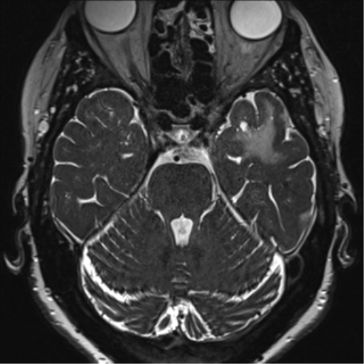Anterior temporal pole cysts (Radiopaedia 46629-51102 Axial 29).png