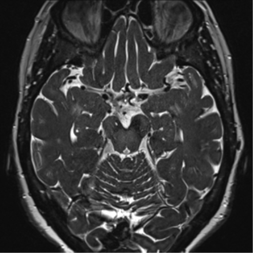 Anterior temporal pole cysts (Radiopaedia 46629-51102 Axial 47).png
