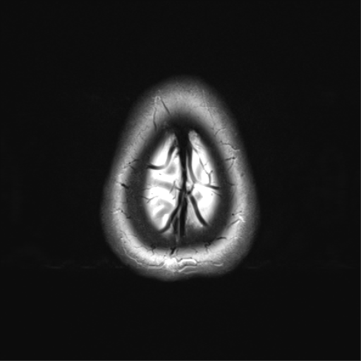 File:Anterior temporal pole cysts (Radiopaedia 46629-51102 C 36).png