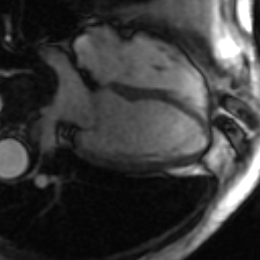 File:Anteroseptal hypokinesia after myocardial infarction (Radiopaedia 15978-15633 4 chamber view SSFE 28).jpg