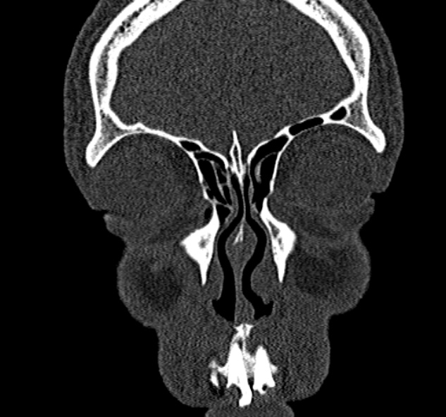 Antrochoanal polyp (Radiopaedia 30002-30554 Coronal bone window 20).jpg