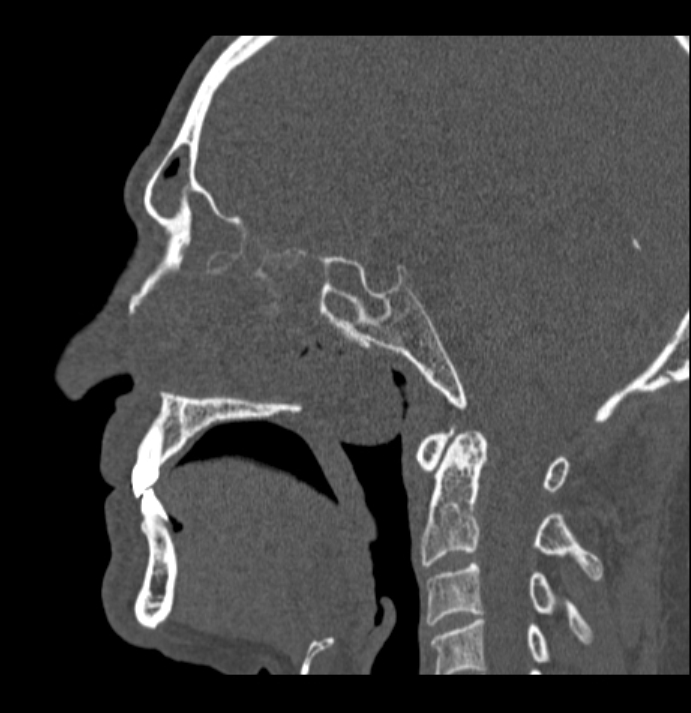 Antrochoanal polyp (Radiopaedia 79011-92169 Sagittal bone window 27).jpg