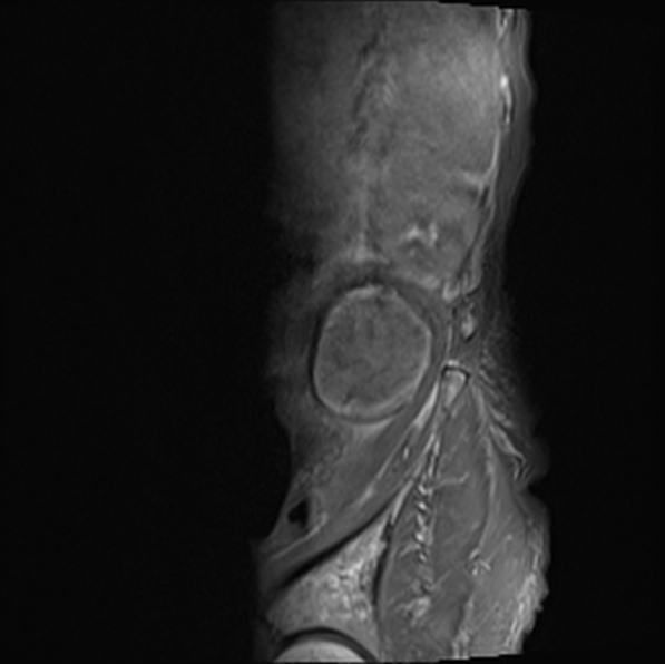 File:Aortic aneurysm with spinal destruction (Radiopaedia 42301-45409 Sagittal T1 fat sat 5).jpg