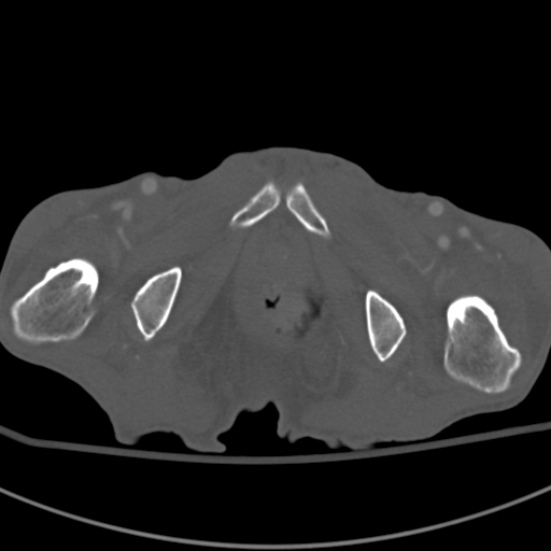 Aortic aneurysm with spinal destruction (Radiopaedia 42301-45410 Axial bone window 120).jpg
