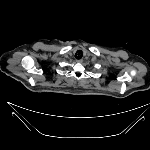 Aortic arch aneurysm (Radiopaedia 84109-99365 Axial non-contrast 25).jpg