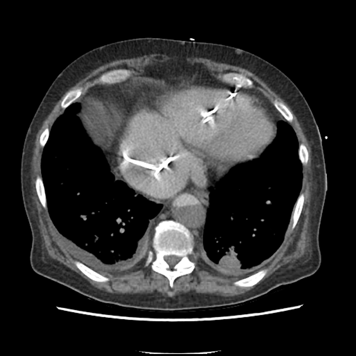 Aortic arch graft infection (FDG PET-CT) (Radiopaedia 71975-82437 A 47).jpg