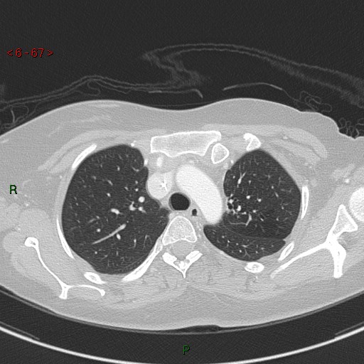 Aortic arch origin of left vertebral artery (Radiopaedia 51520-57286 Axial lung window 67).jpg