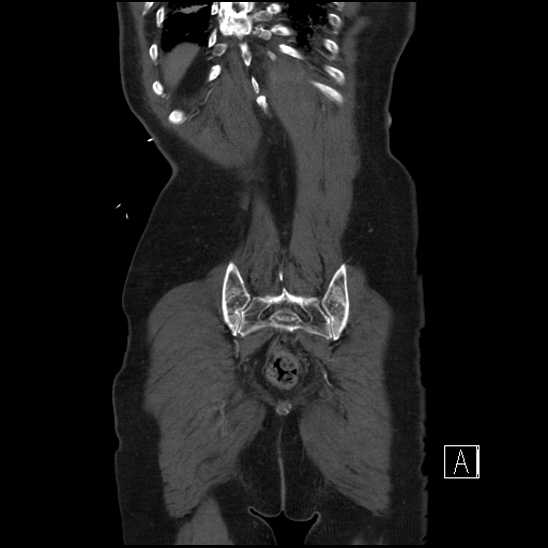 Aortic dissection (CTPA) (Radiopaedia 75506-86750 F 68).jpg