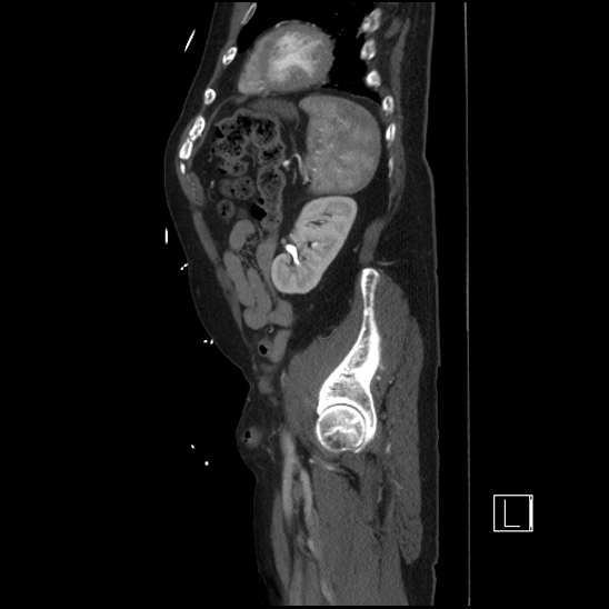 Aortic dissection (CTPA) (Radiopaedia 75506-86750 G 85).jpg