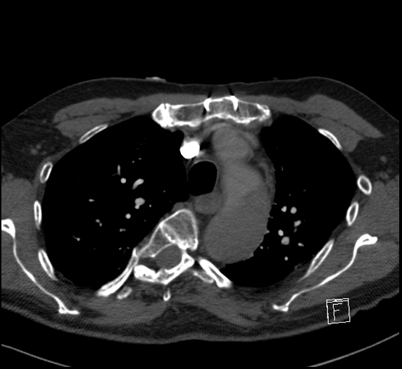 File:Aortic dissection (CTPA) (Radiopaedia 75506-86751 Axial C+ CTPA 39).jpg