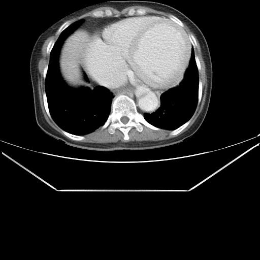 File:Aortic dissection (Radiopaedia 25350-25604 C 39).jpg