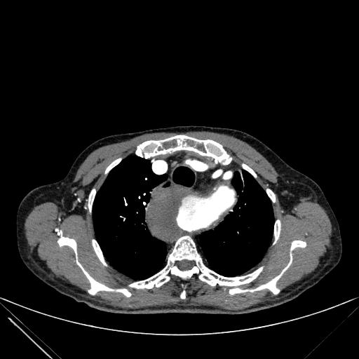 Aortic dissection (Radiopaedia 27466-27665 C+ arterial phase 21).jpg