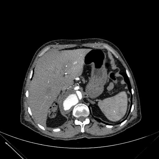 Aortic dissection (Radiopaedia 27466-27665 C+ arterial phase 273).jpg