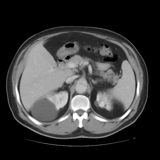Aortic dissection (Radiopaedia 44411-48061 C 75).jpg