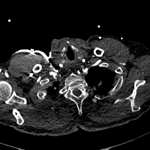 File:Aortic dissection - DeBakey type II (Radiopaedia 64302-73082 A 9).png
