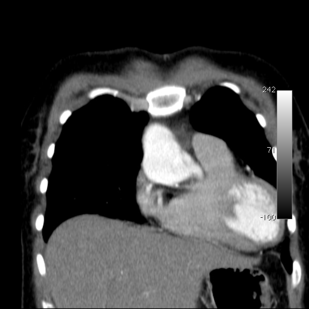 Aortic dissection - Stanford type A (Radiopaedia 29247-29659 B 16).jpg