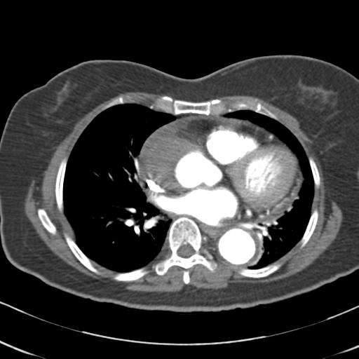File:Aortic dissection - Stanford type A (Radiopaedia 39073-41259 A 45).png