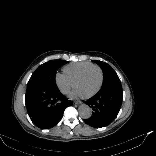 Aortic dissection - Stanford type A (Radiopaedia 83418-98500 Axial non-contrast 29).jpg