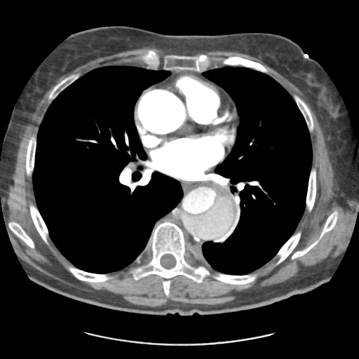 File:Aortic dissection - Stanford type B (Radiopaedia 50171-55512 A 27).png