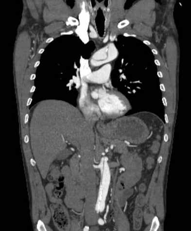 File:Aortic dissection - Stanford type B (Radiopaedia 73648-84437 B 55).jpg