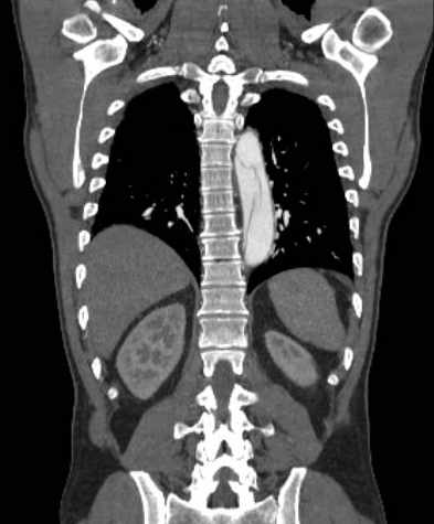 File:Aortic dissection - Stanford type B (Radiopaedia 73648-84437 B 89).jpg