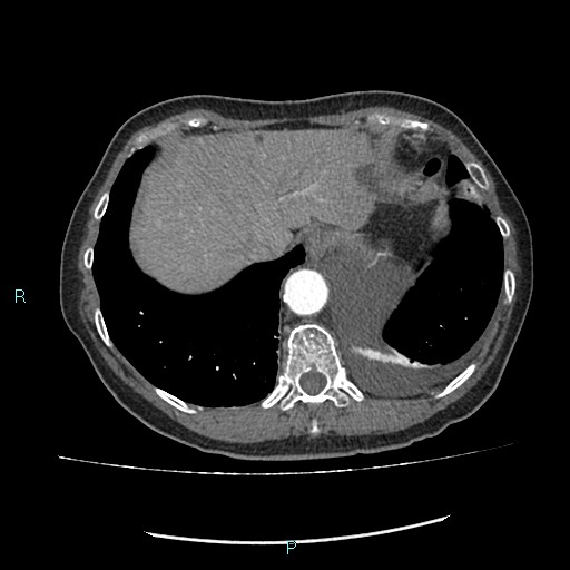 File:Aortic dissection extended to lusory artery (Radiopaedia 43686-47136 B 12).jpg