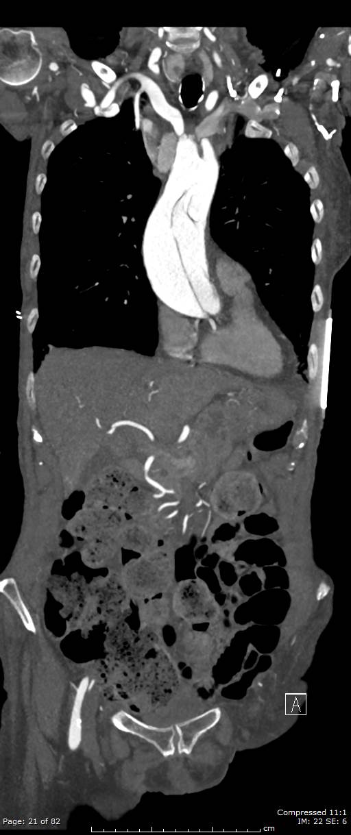 Aortic dissection with extension into aortic arch branches (Radiopaedia 64402-73204 A 21).jpg