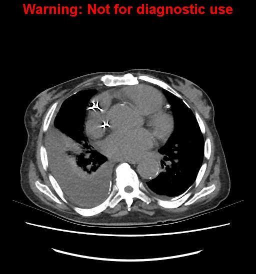 Aortic graft infection (Radiopaedia 44979-48907 Axial non-contrast 4).jpg
