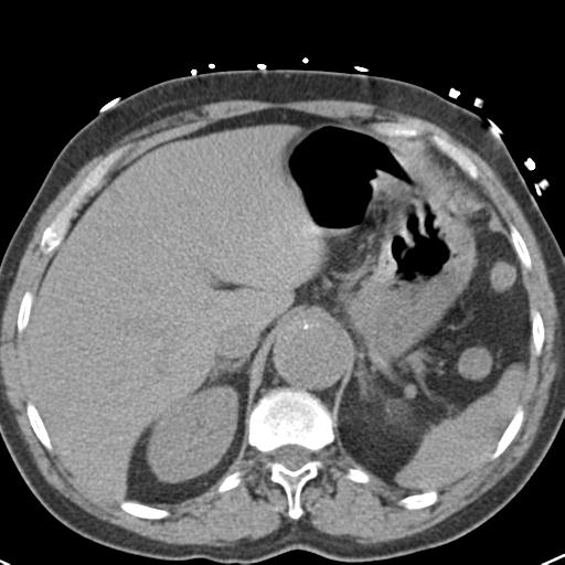 Aortic intramural hematoma (Radiopaedia 31139-31838 Axial non-contrast 50).jpg