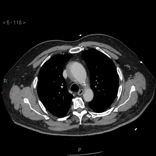 Aortic intramural hematoma (Radiopaedia 48463-53380 C 54).jpg