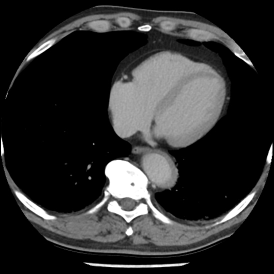 Aortic intramural hematoma (type B) (Radiopaedia 79323-92387 Axial C+ delayed 39).jpg