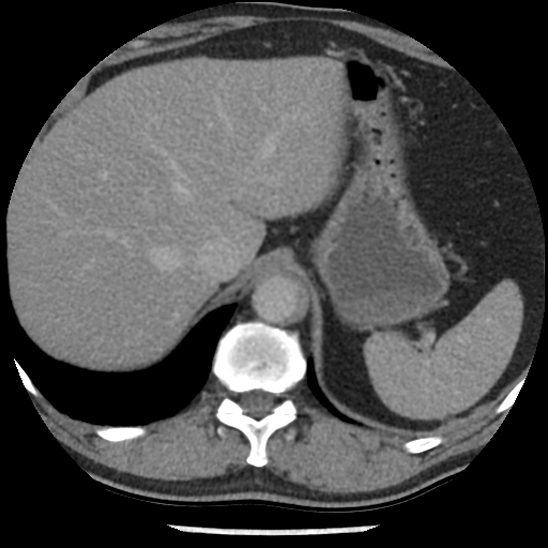 File:Aortic intramural hematoma (type B) (Radiopaedia 79323-92387 Axial C+ delayed 51).jpg