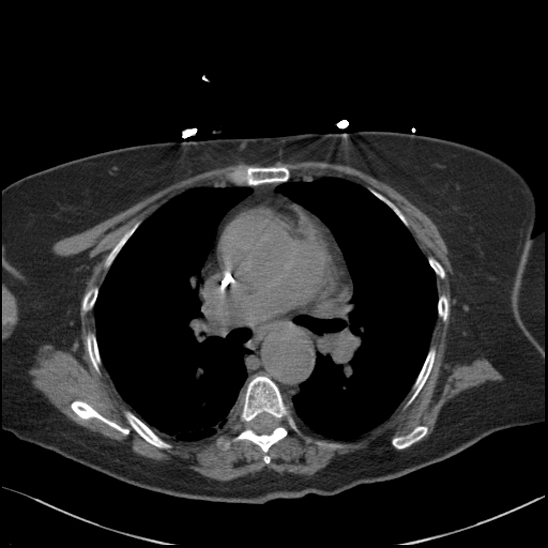 Aortic intramural hematoma with dissection and intramural blood pool (Radiopaedia 77373-89491 Axial non-contrast 43).jpg