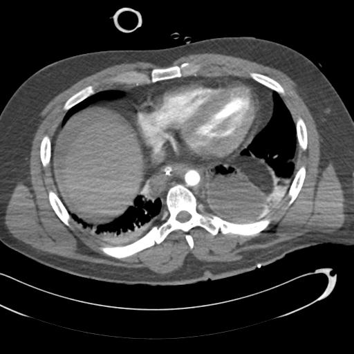 Aortic transection, diaphragmatic rupture and hemoperitoneum in a complex multitrauma patient (Radiopaedia 31701-32622 A 60).jpg