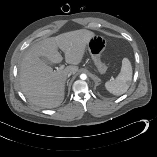 Aortic transection, diaphragmatic rupture and hemoperitoneum in a complex multitrauma patient (Radiopaedia 31701-32622 A 84).jpg