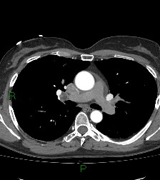 Aortic valve endocarditis (Radiopaedia 87209-103485 C 40).jpg