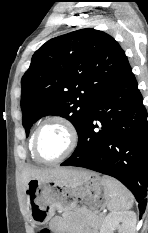 Aortic valve non-coronary cusp thrombus (Radiopaedia 55661-62189 C+ arterial phase 8).png