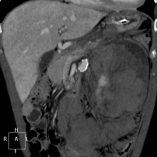 Aorto-left renal vein fistula (Radiopaedia 45534-49628 B 15).jpg