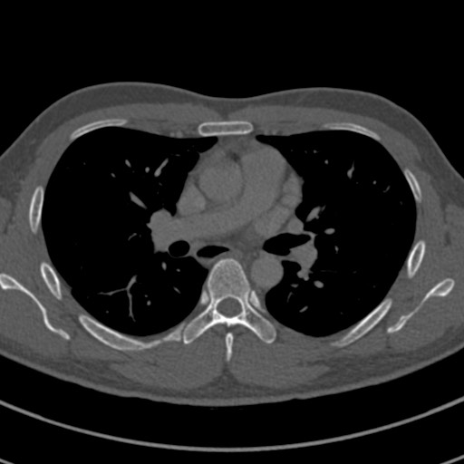 Apical lung mass mimic - neurogenic tumor (Radiopaedia 59918-67521 Axial bone window 38).jpg