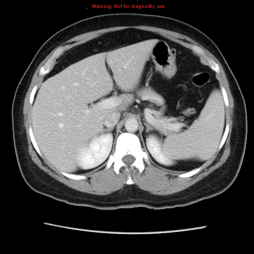 File:Appendiceal mucinous cystadenoma (Radiopaedia 8263-9111 Axial liver window 25).jpg