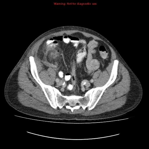 File:Appendicitis mass in inguinal hernia (Radiopaedia 26858-27029 A 12).jpg