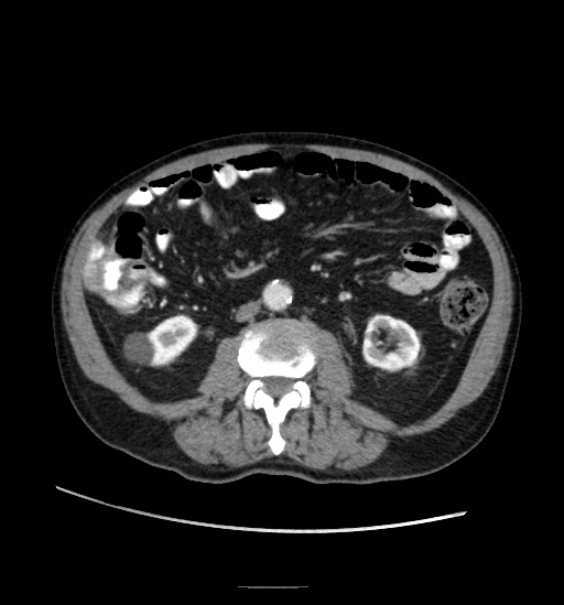 Appendicitis with localized perforation and abscess formation (Radiopaedia 49035-54130 A 47).jpg