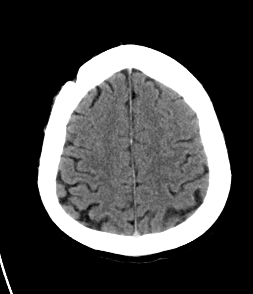 File:Aqueduct stenosis with corpus callosum hypoattenuation post shunting (Radiopaedia 37212-38973 Axial non-contrast 26).png