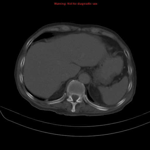 File:Arachnoiditis ossificans (Radiopaedia 51394-57136 Axial bone window 4).jpg
