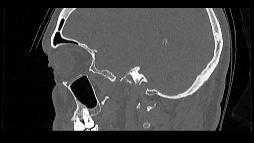 Arcuate foramen (Radiopaedia 89833-106944 Sagittal bone window 109).jpg