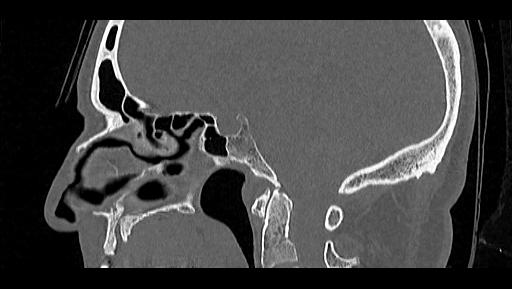 Arcuate foramen (Radiopaedia 89833-106944 Sagittal bone window 59).jpg