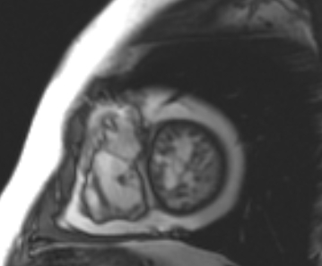 Arrhythmogenic right ventricular cardiomyopathy (Radiopaedia 69431-79307 Short axis cine 54).jpg