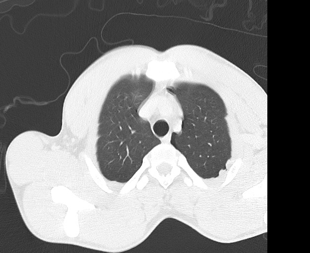 Arrow injury to the chest (Radiopaedia 75223-86321 Axial lung window 1).jpg