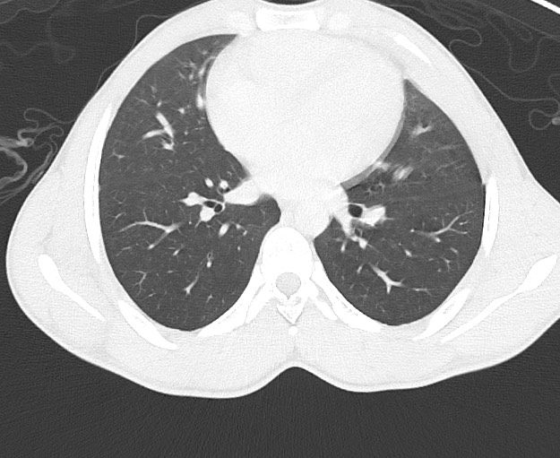 Arrow injury to the chest (Radiopaedia 75223-86321 Axial lung window 48).jpg